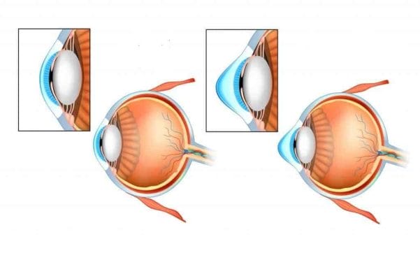 keratoconus ophthalmology clinic medic jukic