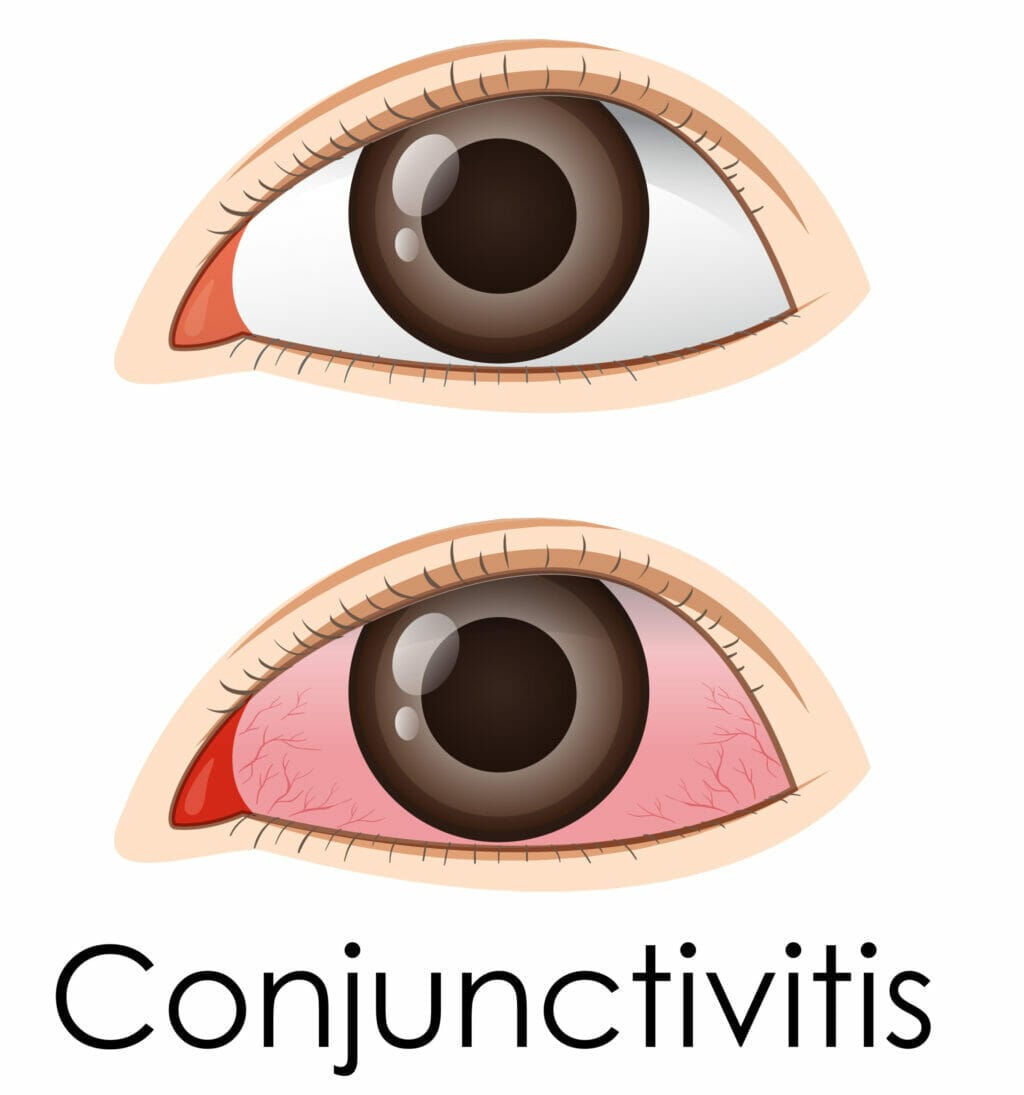 Konjuktivitis - Očna poliklinika Medić Jukić Split