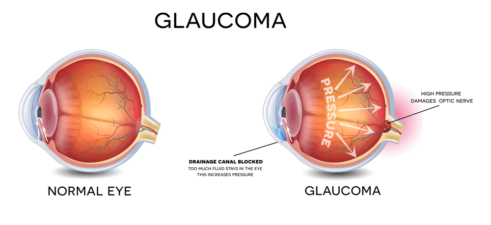 glaucoma ophthalmology clinic medic jukic