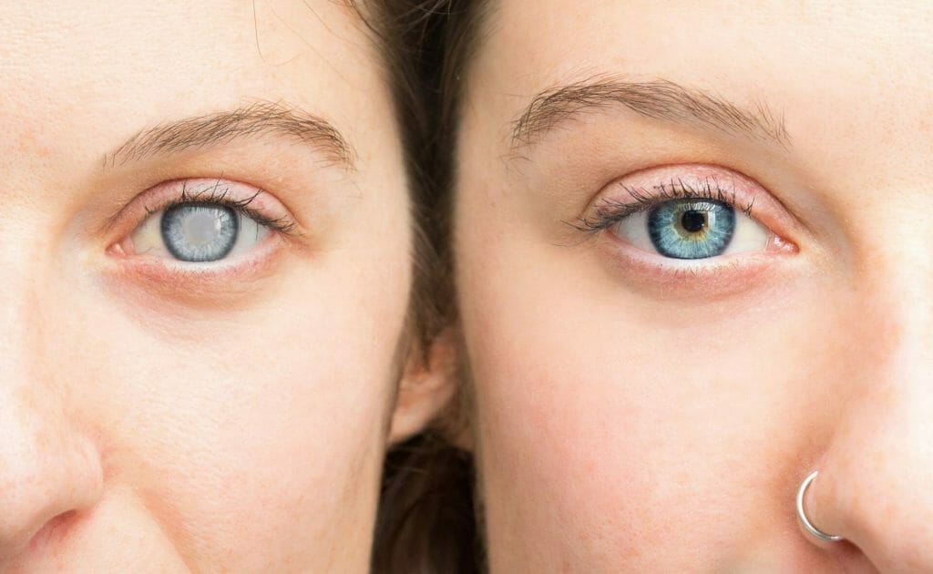 Dijabetička retinopatija - Očna poliklinika Medić-Jukić